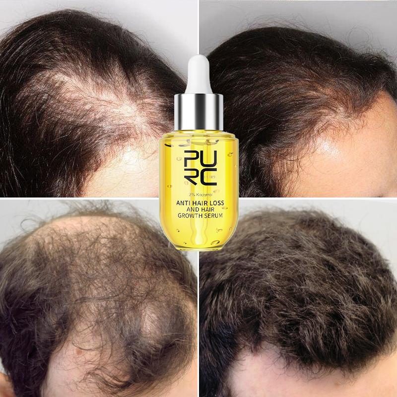 PURC New Hair Growth Products Ginger Serums Polygonum Multiflorum Hair Loss Treatment Hair Care Beauty Health for Men Women